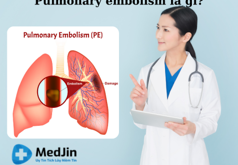 Pulomonary embolism là gì? Tất Tần Tật Thông Tin Bạn Cần Biết