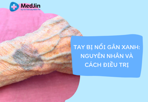 Tay bị nổi gân xanh: Nguyên nhân và cách chữa trị