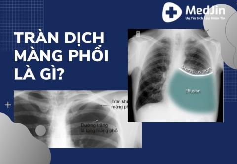 Tràn dịch màng phổi là gì?
