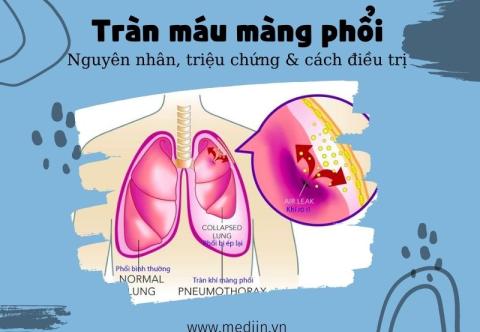 Tràn Máu Màng Phổi - Nguyên Nhân, Triệu Chứng, Chẩn Đoán Và Cách Điều Trị