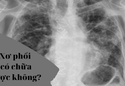 Bệnh Xơ Phổi Có Nguy Hiểm Không? Có Chữa Được Không?