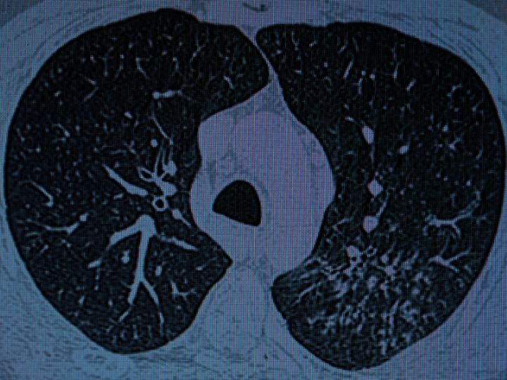 Những thông tin cần biết về thâm nhiễm 1/3 phổi 