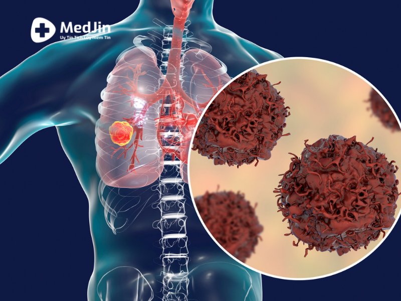 Có phải ung thư phổi có tiềm ẩn trong cơ thể và có khả năng lây nhiễm sau này không?
