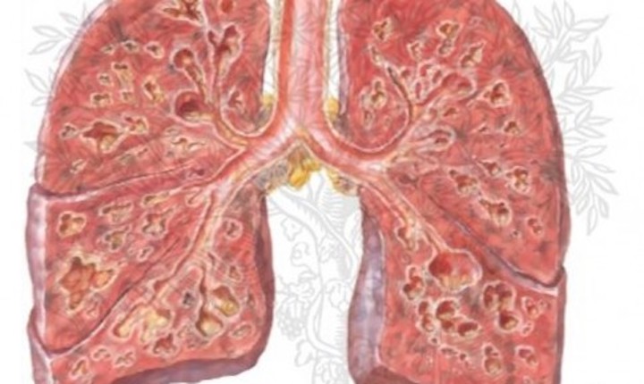 Xơ phổi có lây không – Những điều cần biết