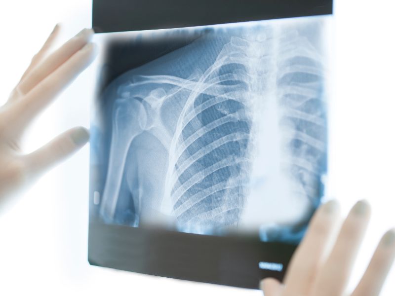 Có những điều cần chuẩn bị trước khi chụp X quang phổi bình thường không?
